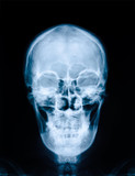 X-ray picture of skull