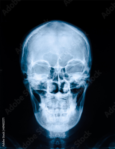 X-ray picture of skull