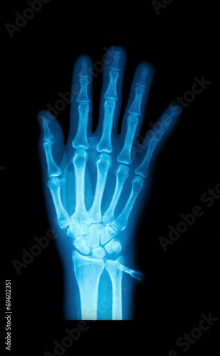 X-Ray image of human hands