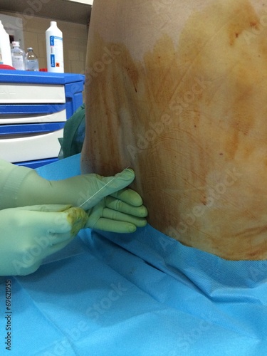anestesia