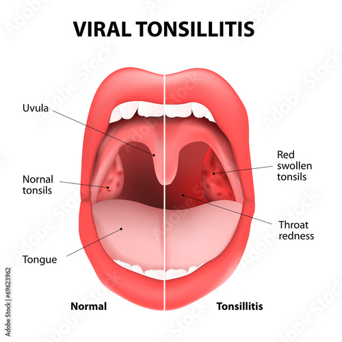viral tonsillitis photo