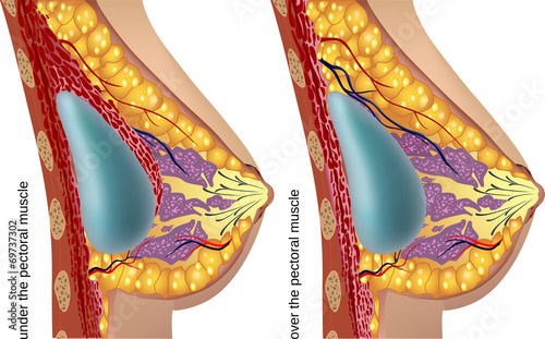Plastic surgery of breast implants. Vector