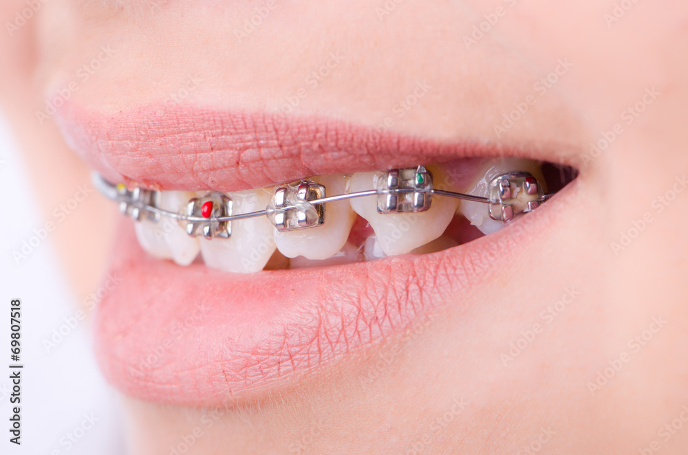 Fototapeta premium Mouth with brackets braces in medical concept