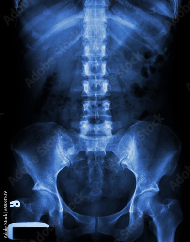 X-ray lumbo-sacral spine and pelvis of asian adult people