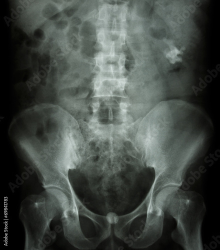 Left kidney stone and bladder stone photo