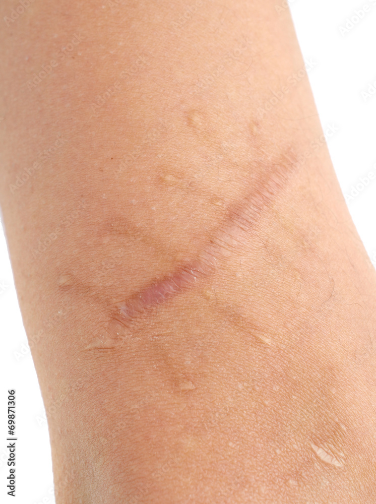 Fototapeta premium The scar.