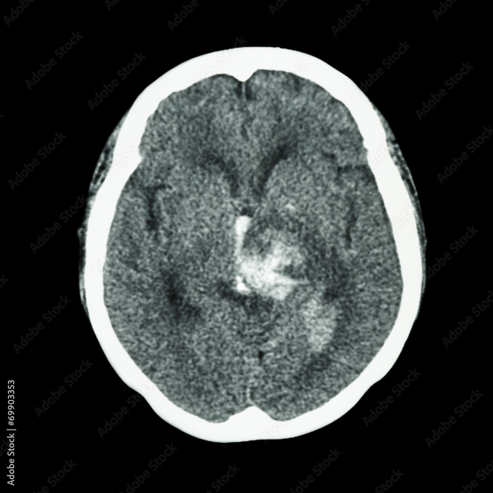 CT scan of brain : show hemorrhagic stroke CT scan of brain : show hemorrhagic stroke