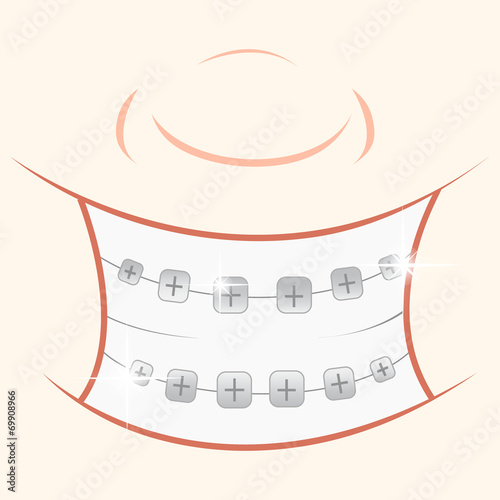 Braces in the mouth of a teen