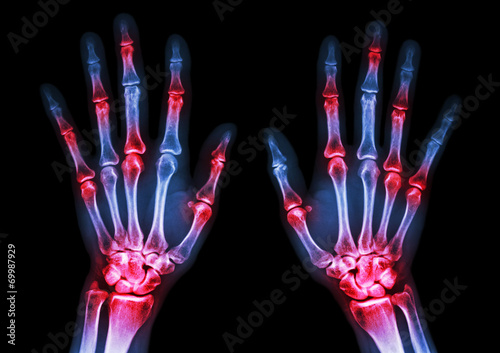 arthritis at multiple joint of hands (Gout,Rheumatoid)