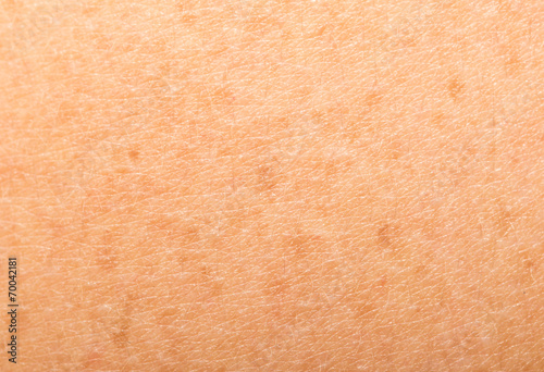 freckles on human skin