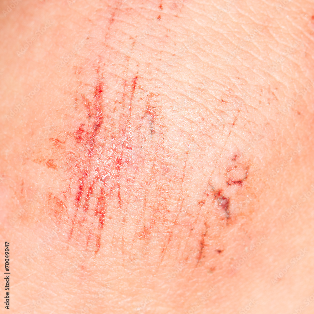 Fototapeta premium wound on the skin. close-up