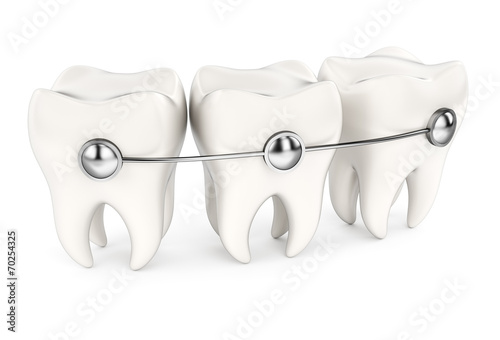 Teeth with braces