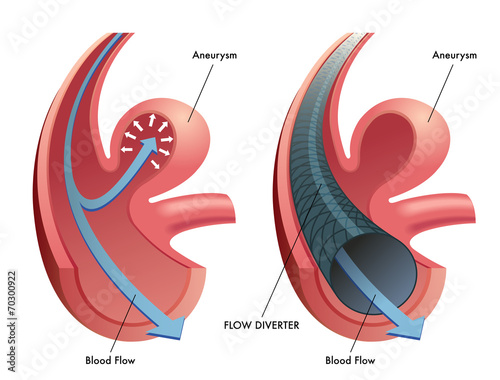 flow diverter