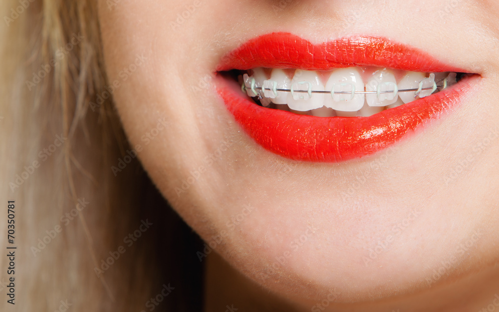 Smiling girl with braces face part teeth straighten Smiling girl with braces face part teeth straighten