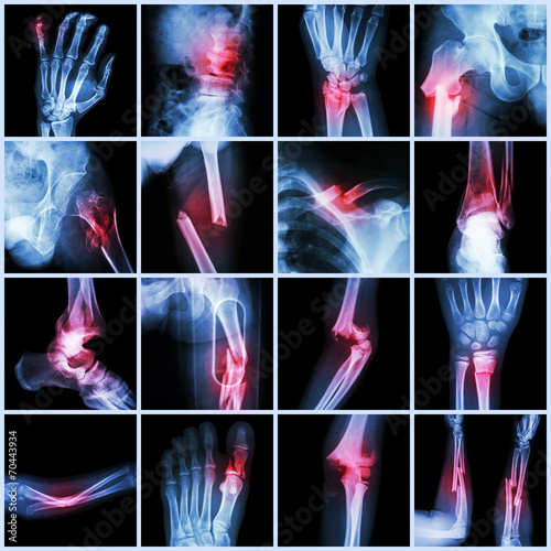 Fotografia, Obraz Collection X-ray multiple bone fracture