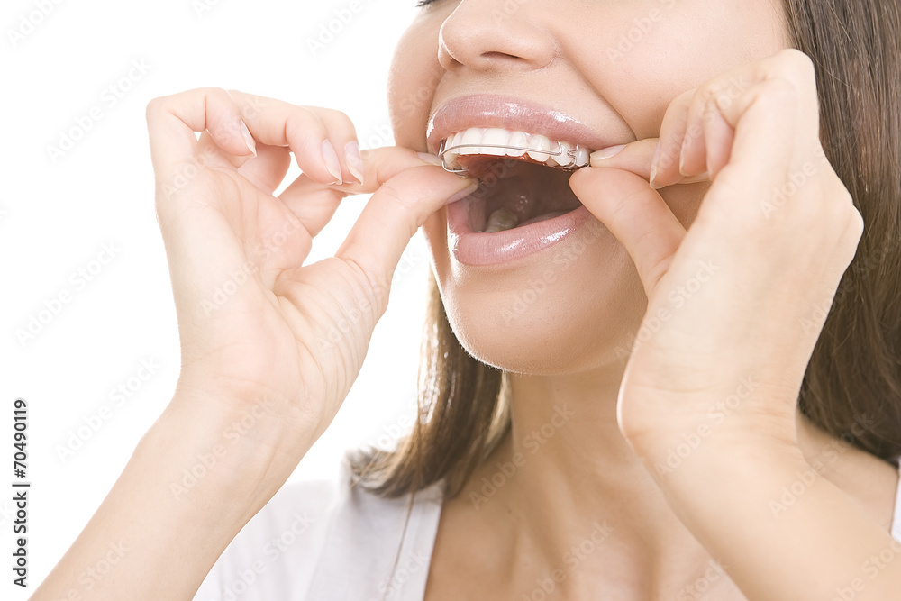 Beautiful smiling girl with retainer for teeth Beautiful smiling girl with retainer for teeth