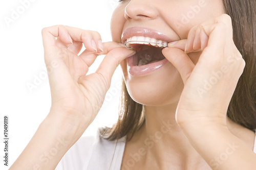 Beautiful smiling girl with retainer for teeth