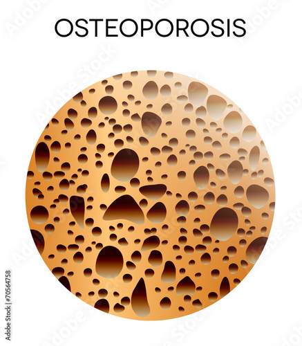 Human bone disease- osteoporosis