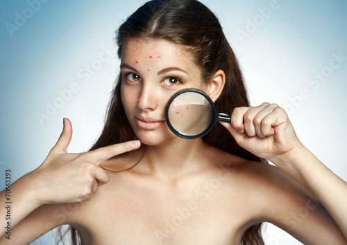Girl with a pimply face holding magnifying glass. skin care