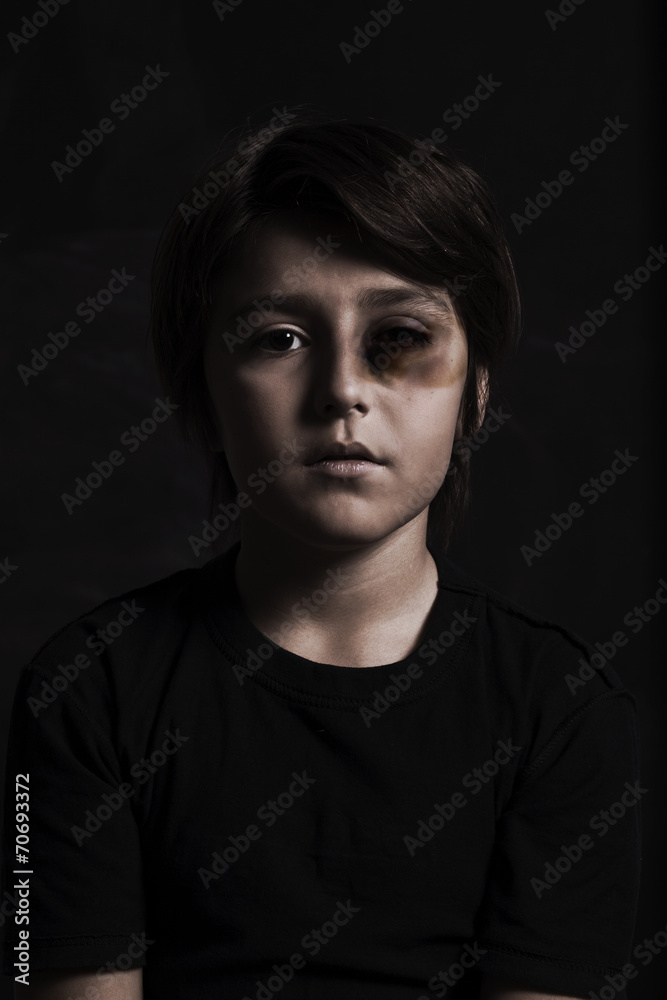 Fototapeta premium Little boy badly beaten up, with wounds on his face