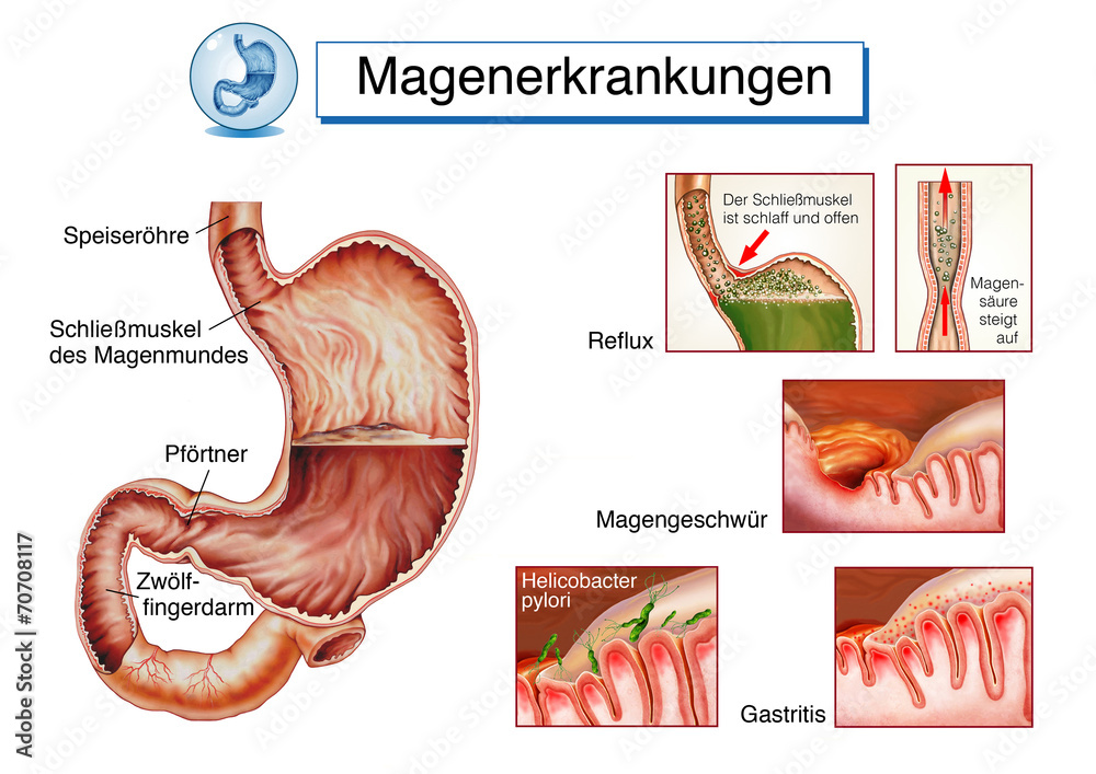 Illustrazione Stock Magenerkrankungen.Geschwür.Reflux.Gastritis | Adobe