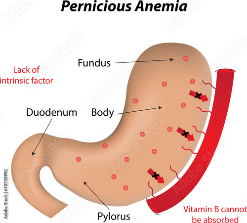 Pernicious Anemia