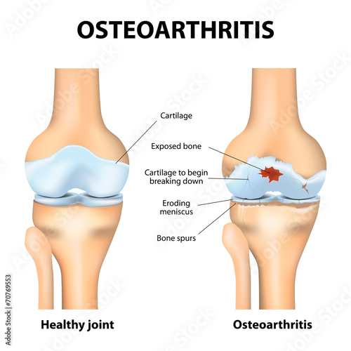 Osteoarthritis or arthritis
