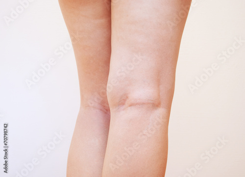 40代の女性の膝の裏 Stock Photo Adobe Stock