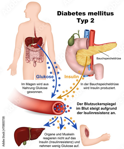diabetes mellitus typ 2 a diabetic neuropathy treatment guidelines 2021