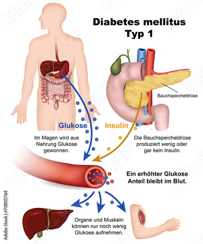 diabetes mellitus typ 1)