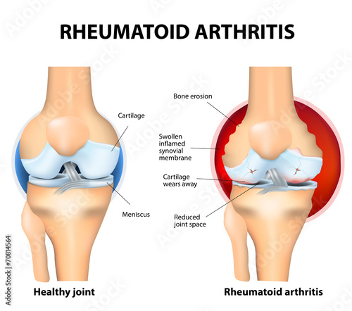 Normal Joint and Rheumatoid Arthritis photo