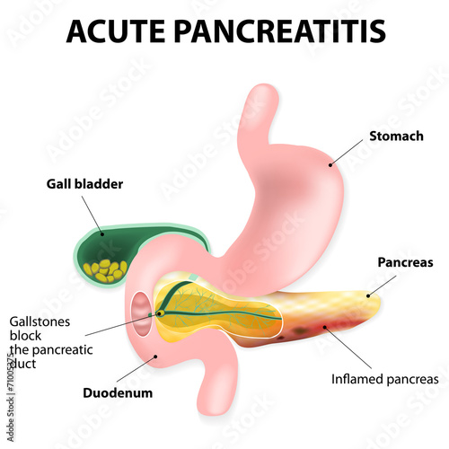 Acute pancreatitis