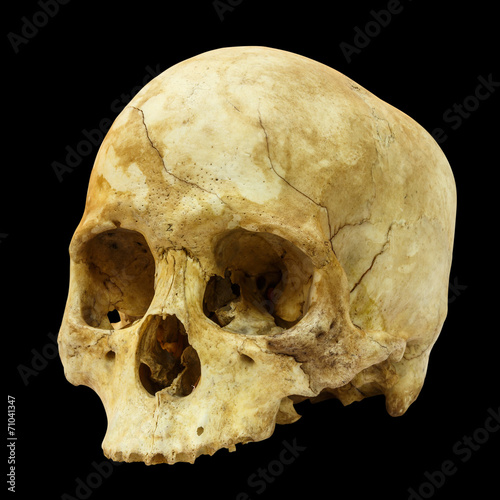 Human Skull Fracture(side) (,Asian)