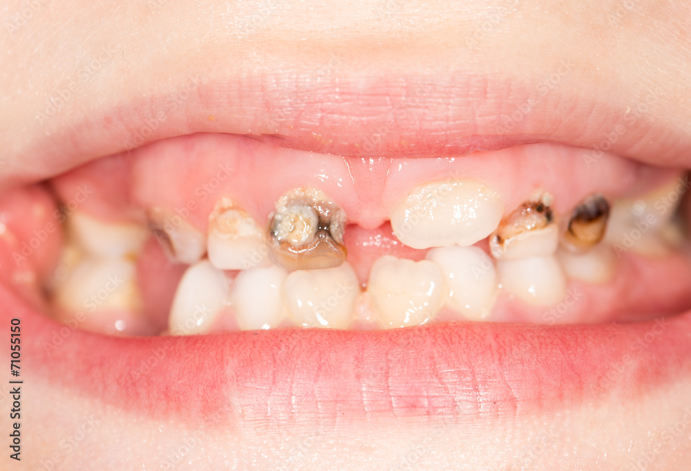 Fototapeta premium bad teeth in the mouth. close-up