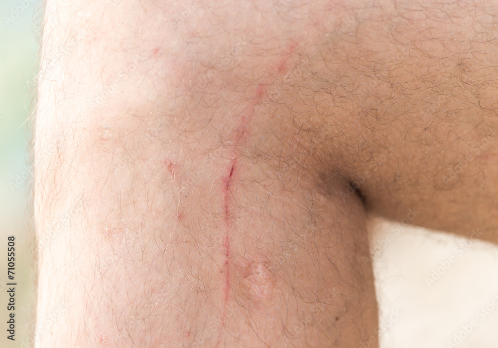 Naklejka premium scars on his leg