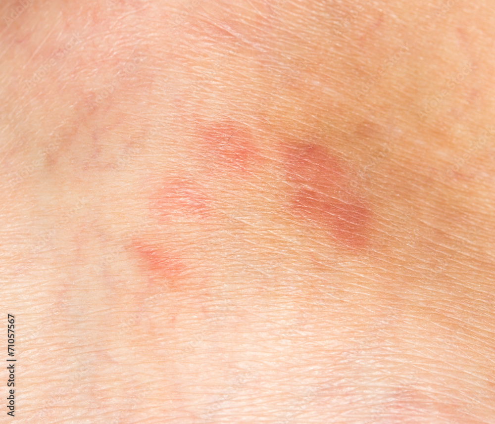 Fototapeta premium mosquito bites on the skin. close-up