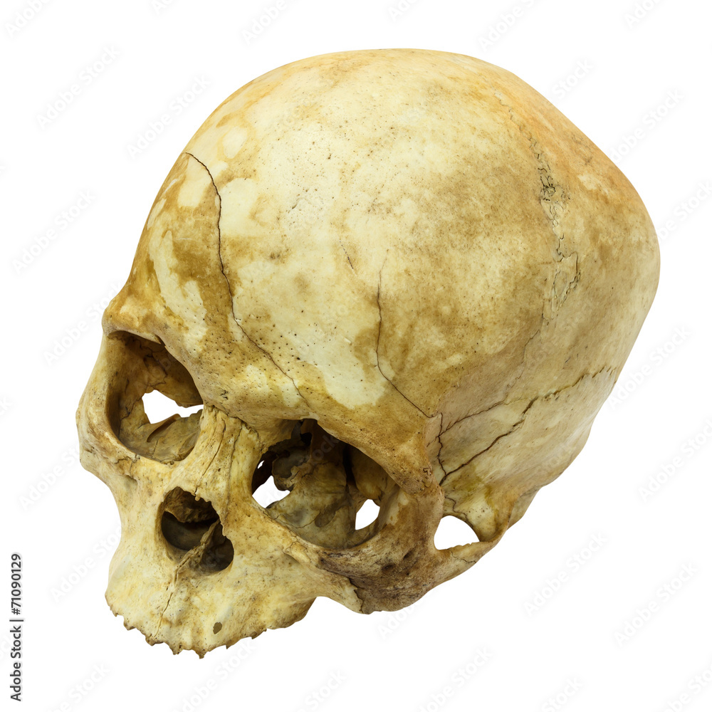 Human Skull Fracture(top side,apex)(,Asian) on isolated Human Skull Fracture(top side,apex)(,Asian) on isolated