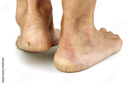 Cracked heels on white background
