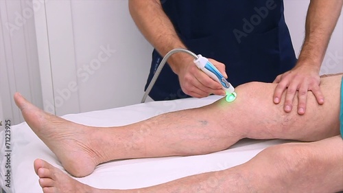 Laser yag therapy photo