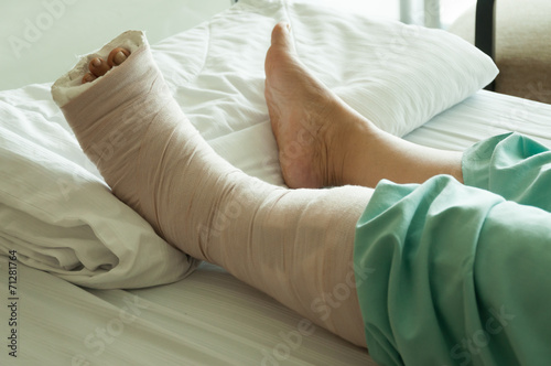 Broken Leg