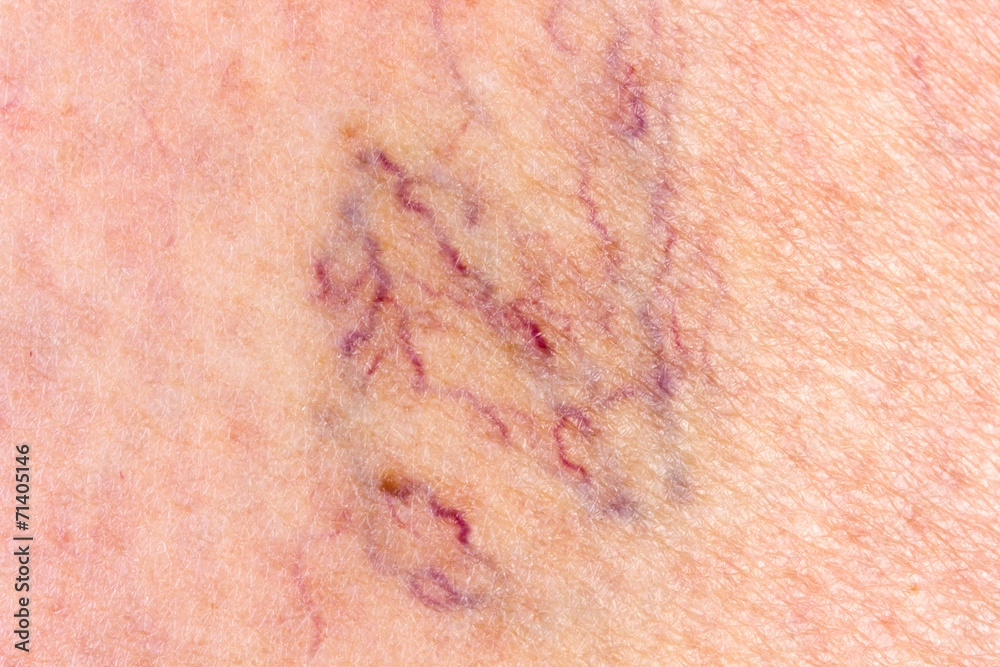 Fototapeta premium Close-up of leg with varicose veins