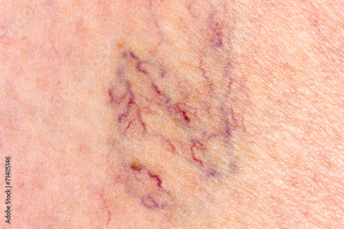 Close-up of leg with varicose veins