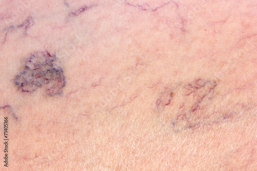 Leg full of varicose veins