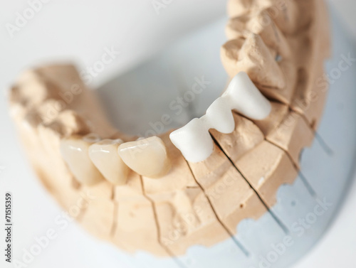 Obraz na plátně Dental prothetic