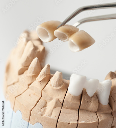 Canvas Print Dental prothetic