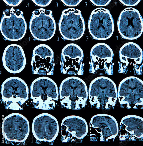 Billede på lærred Mri Brain Scan