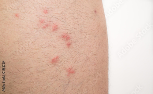 Tableau sur toile flea bites on caucasian man leg