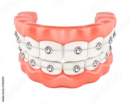 Jaws with dental braces