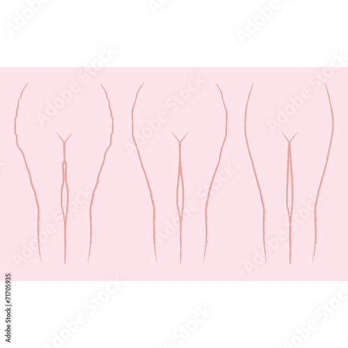 cellulite