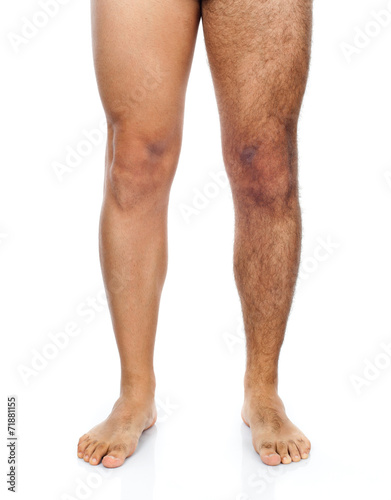 Tablou canvas Male hair removal on legs